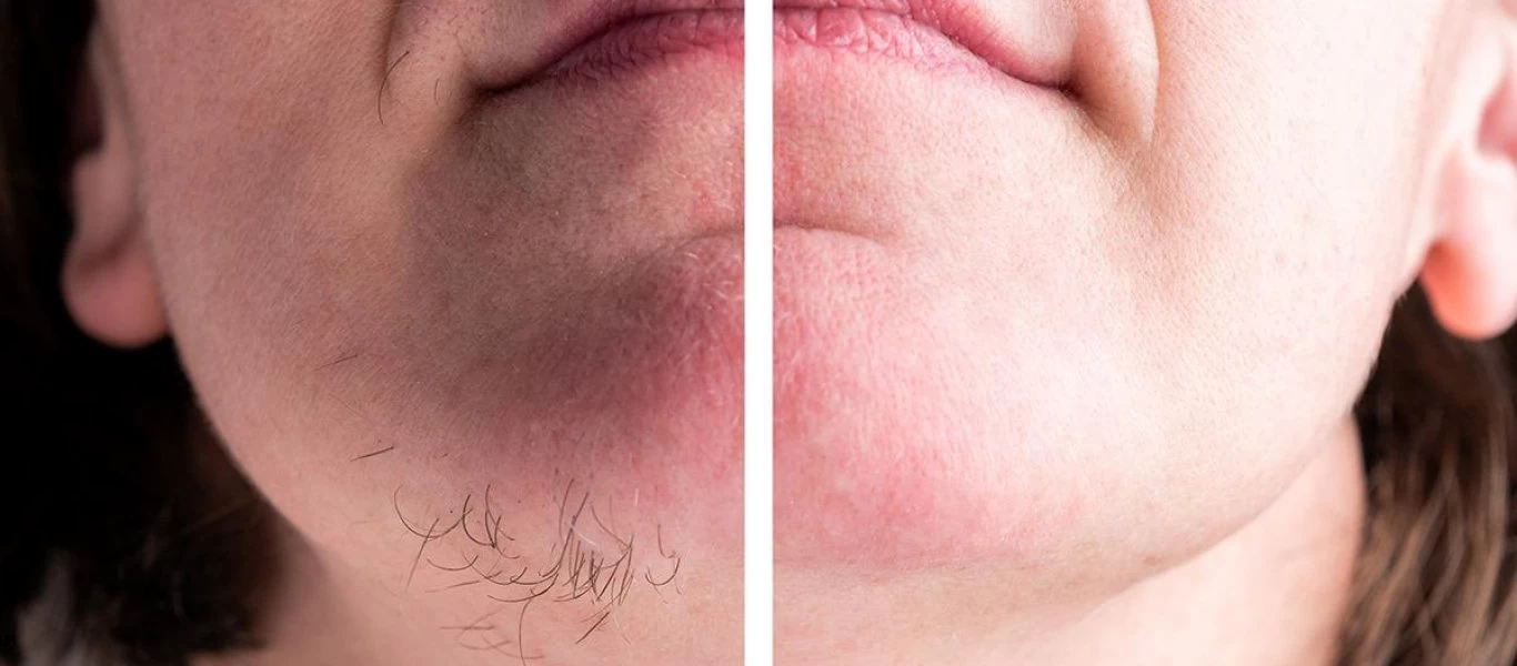 Οι δύο φυσικοί τρόποι για να απαλλαγείτε από την ανεπιθύμητη τριχοφυΐα